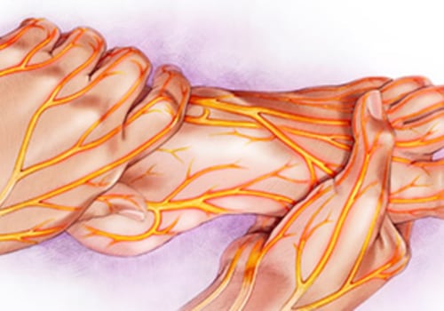 How can neuropathy be cured?